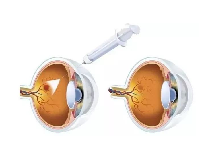 玻璃體腔注藥術(Avastin)手術
